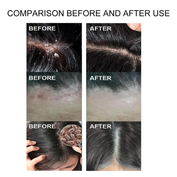 50g Sulfur Shampoo Remove Lice Mites Dandruff Itching Oil Cleaning Scalp Deep Hair Antipruritic Follicles Cleaning Hair Care