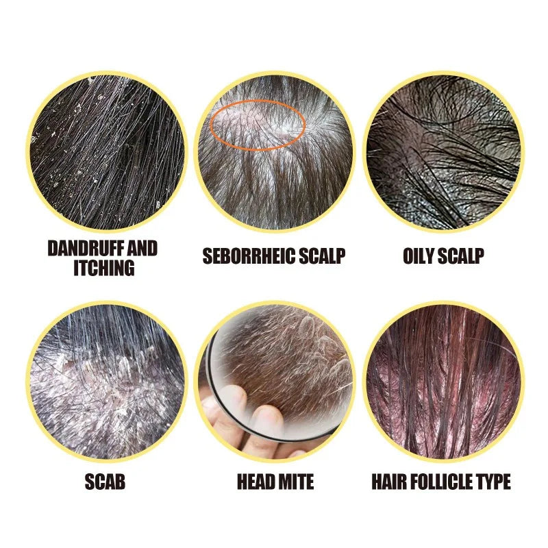 50g Sulfur Shampoo Remove Lice Mites Dandruff Itching Oil Cleaning Scalp Deep Hair Antipruritic Follicles Cleaning Hair Care