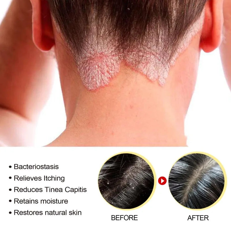 50g Sulfur Shampoo Remove Lice Mites Dandruff Itching Oil Cleaning Scalp Deep Hair Antipruritic Follicles Cleaning Hair Care
