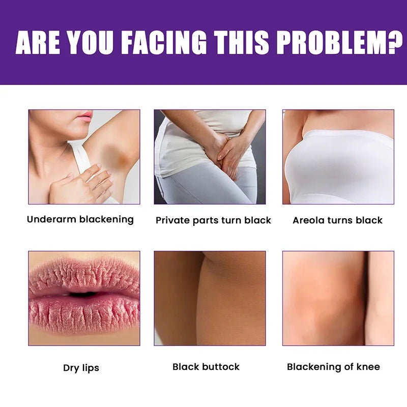 Whitening Cream Private Parts Underarm Bleaching Whiten Butt Knee Brighten Inner Thigh Intimate Parts Dark Remove Melanin Care